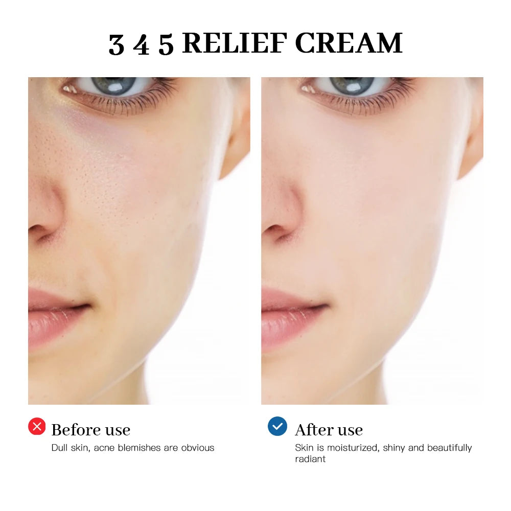 Relief Cream – Brightening & Acne Mark Repair Moisturizer